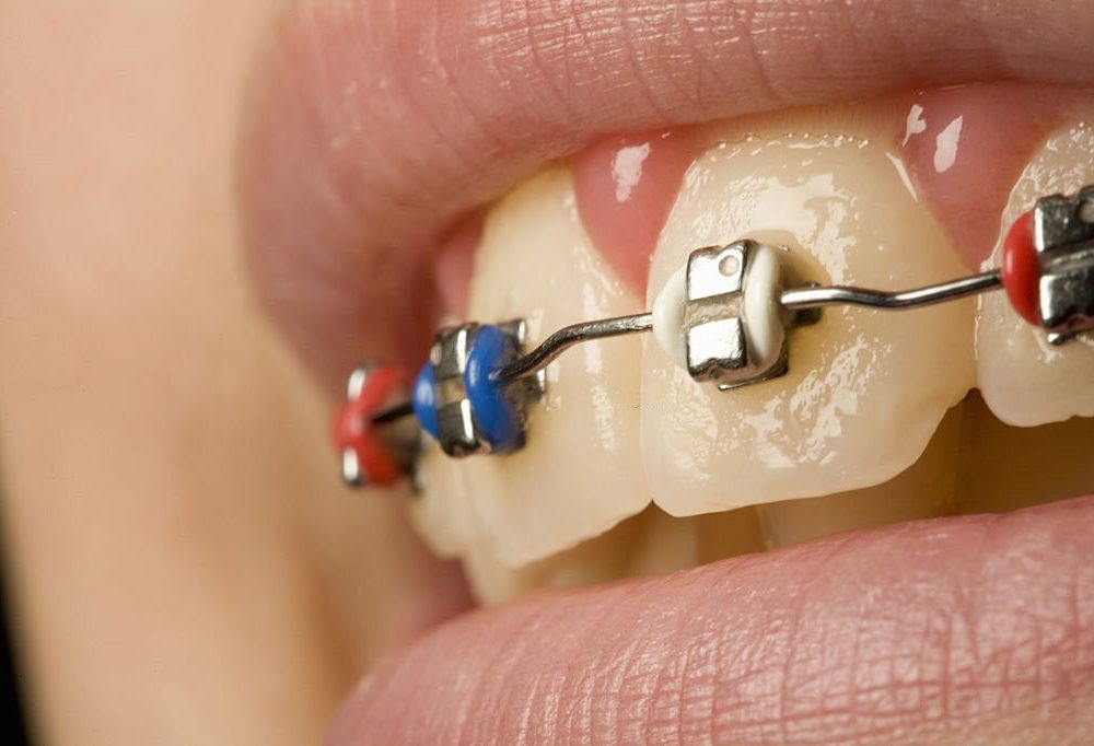 How Much Do Braces Hurt On A Scale 1-10?