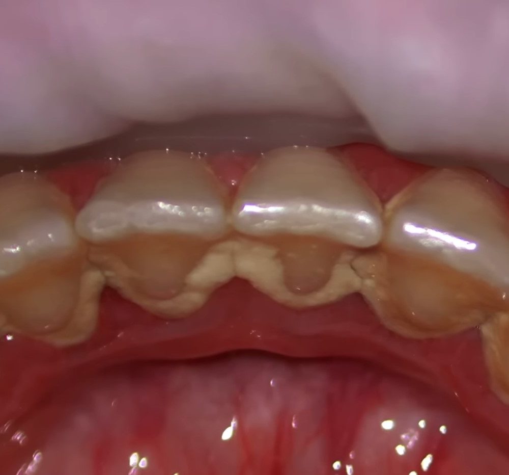 How To Remove Tartar From Teeth Without Dentist