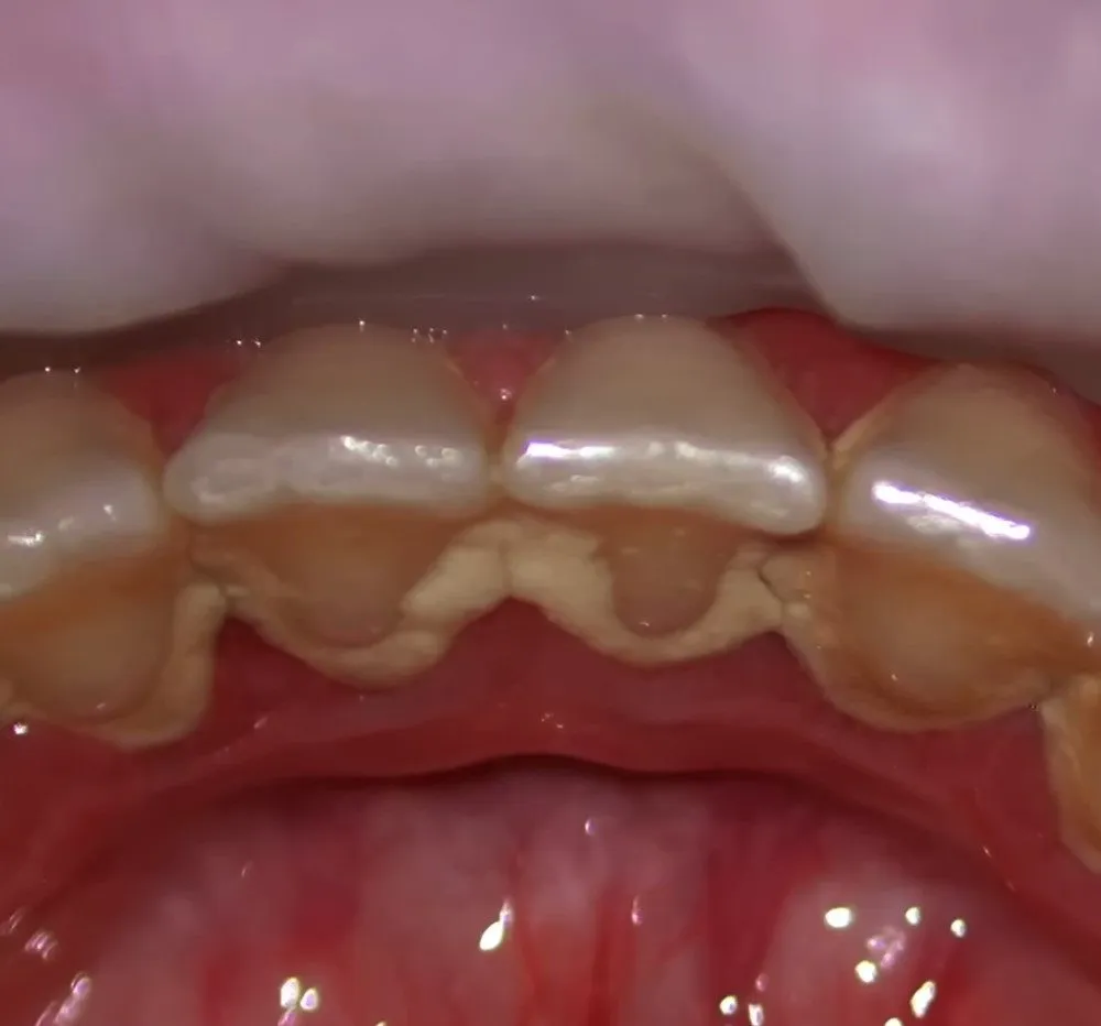 Plaque vs. Tartar and How To Remove Them At Home