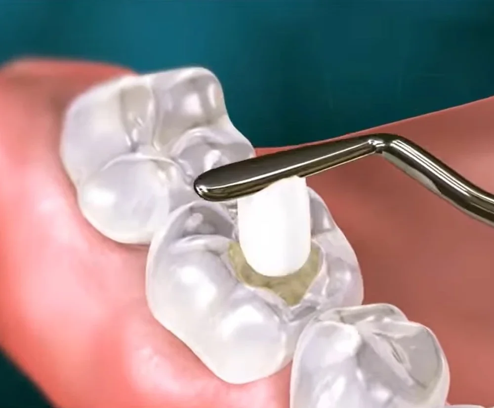 How Long Does a Cavity Filling Take